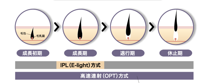 OPT脱毛方式