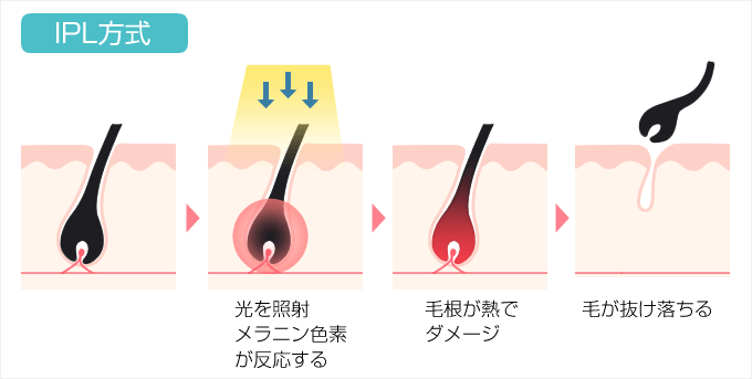 引用:https://tsuru-hada.jp/ipl-ssc-shr/