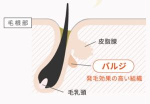 ハイブリット抑毛