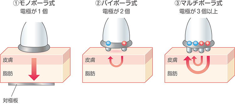 ラジオ波エステ☆ハイパーウェーブプレミアム☆痩身 たるみ 引き締め 